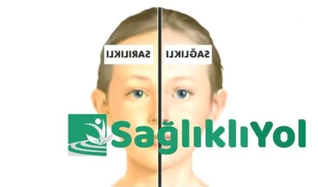 Sarılığa İyi Gelen Yiyecekler