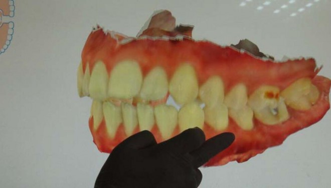 Korona virüs diş ağrılarını artırdı